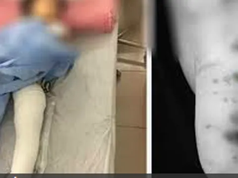 Cháu bé 2 tuổi bị chó Pitbull cắn thương tâm