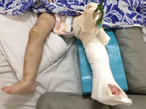 Tức giận vì quấy khóc mẹ nuôi đánh bé gái một tuổi gãy chân