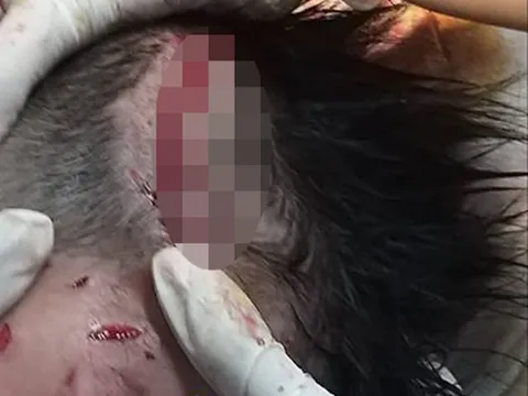 Bé trai 4 tuổi ở Hà Tĩnh bị chó béc giê nhà lao vào cắn xé lóc 13cm da đầu