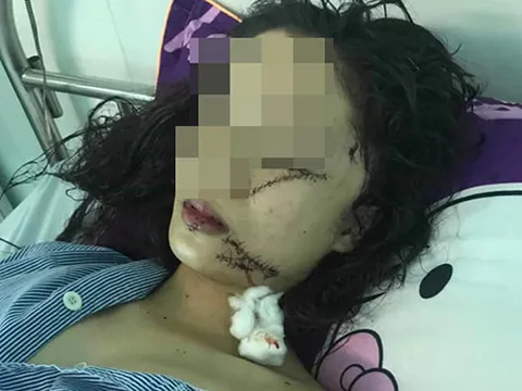 Thiếu nữ bị ba bạn gái vây đánh, rạch mặt trong đêm khâu 60 mũi