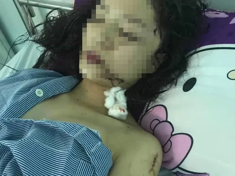 Nguyên nhân khiến thiếu nữ 18 tuổi bị rạch mặt dã man ở Bắc Ninh