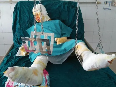 Nạn nhân duy nhất còn sống trong vụ tẩm xăng đốt cả gia đình ở Sơn La