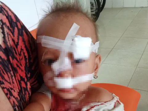 Xác minh thông tin bé 2 tuổi bị bố ném ly trúng mặt, khâu 12 mũi