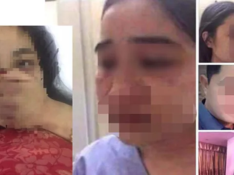 Bộ Y tế yêu cầu làm rõ vụ nữ điều dưỡng bị bác sĩ đánh đập ở Thừa Thiên-Huế