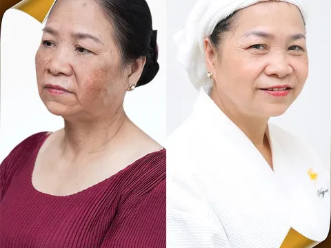 Lối thoát nào cho chị em nám nặng, mất sắc tố, nền da bị phá hủy?