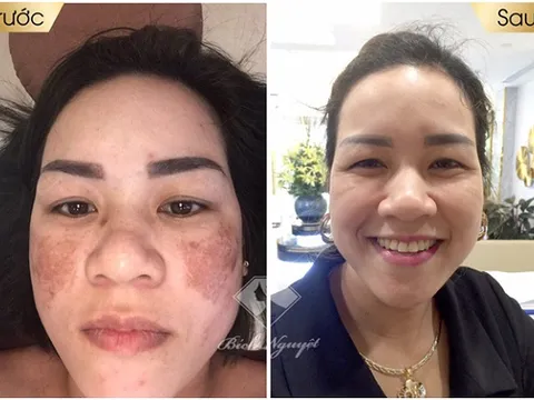 Rũ bỏ gương mặt nhọ nồi cho bà mẹ 2 con bị nám 'ám quẻ' nhờ Phác đồ trị nám tại nhà Bích Nguyệt Lullaby