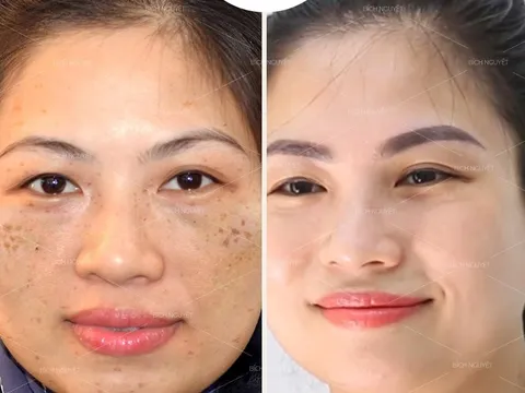 Lần đầu tiên ra mắt 'bom tấn' trị nám tại nhà - phác đồ Bích Nguyệt Lullaby