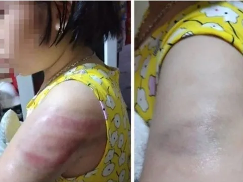 Kỷ luật cô giáo dùng thước đánh học sinh ở Nam Định