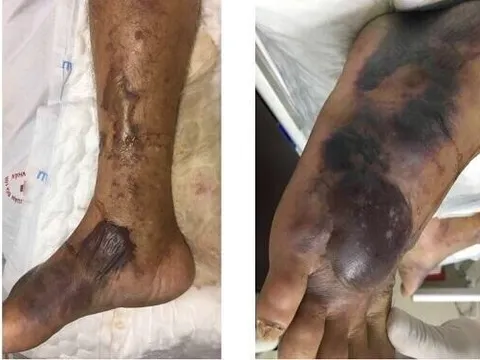 Hải Phòng: Một người đàn ông tử vong vì ăn hải sản chưa nấu chín