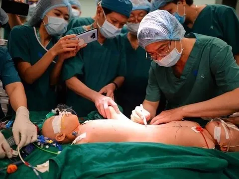 Phẫu thuật tách cặp song sinh: 5 ê-kip bác sĩ đổi ca liên tục