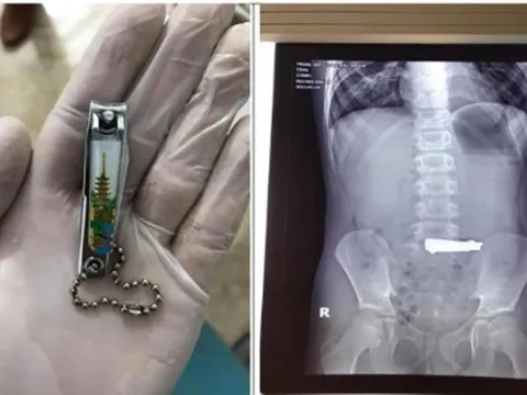 Phú Thọ: Bé trai 9 tuổi bắt chước Youtube nuốt bấm móng tay vào bụng