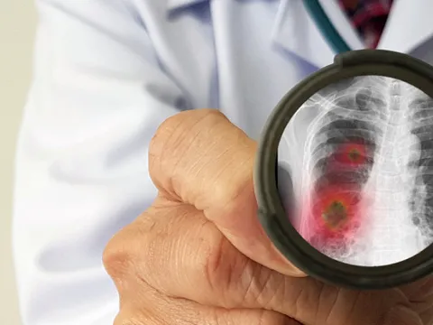 Chuyên gia Nga nêu triệu chứng tổn thương nguy hiểm nhất do virus corona mới gây ra