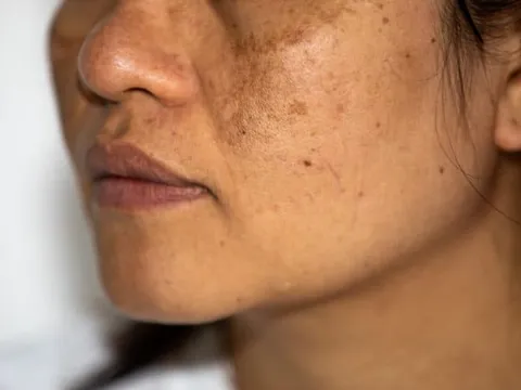 Nám da mặt lâu năm có cách nào chữa tận gốc được không?