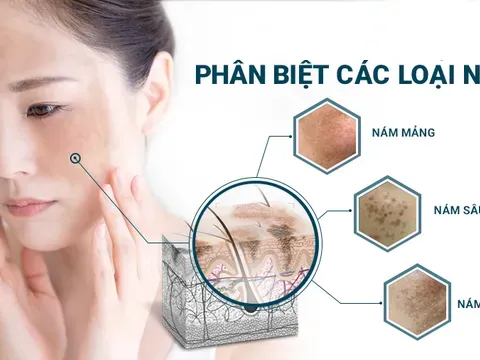 Cách phân biệt tàn nhang và nám chân sâu