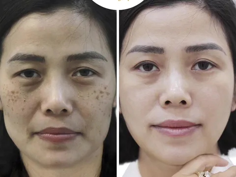 Axit Azelaic chính là 'chân ái' trị nám, chống lão hóa cực kỳ hiệu quả!