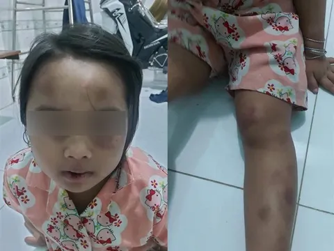 Bình Dương: Tạm giữ vợ chồng cô ruột bạo hành cháu gái 6 tuổi