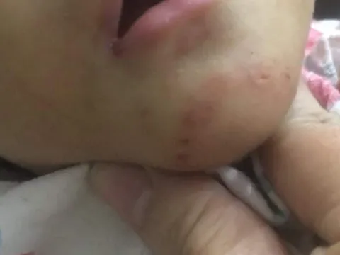 Công an vào cuộc điều tra vụ bé gái 16 tháng tuổi nghi bị mẹ nuôi bạo hành