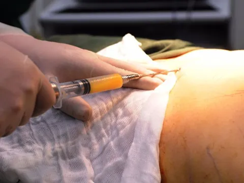 Hút mỡ bụng tại spa 'chui', cô gái trẻ phải nhập viện cấp cứu