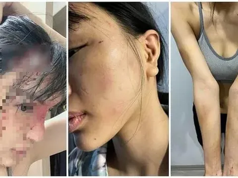 Công an vào cuộc điều tra vụ nữ siêu mẫu tố bị bạn trai hành hung