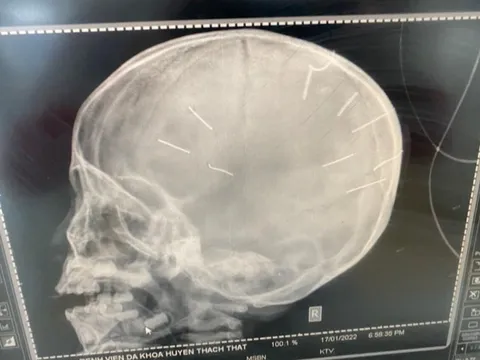 Hà Nội: Bé gái 3 tuổi nghi có 9 đinh găm vào đầu, có dấu hiệu bị bạo hành