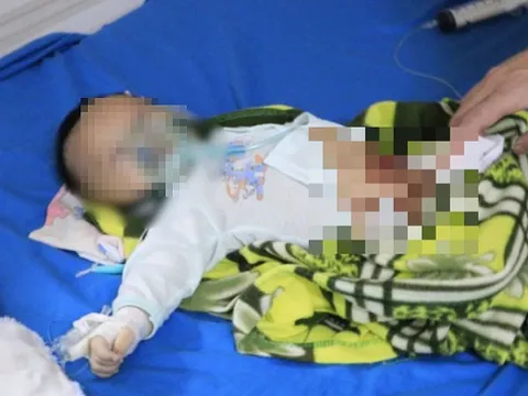 Bé 2 tháng tuổi co giật, tím tái sau khi được đắp tỏi chữa COVID-19