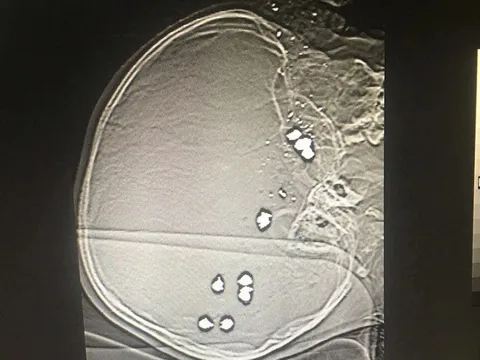 Ninh Bình: Nghịch súng tự chế, bé trai 6 tuổi bị 11 viên đạn bi găm vào đầu