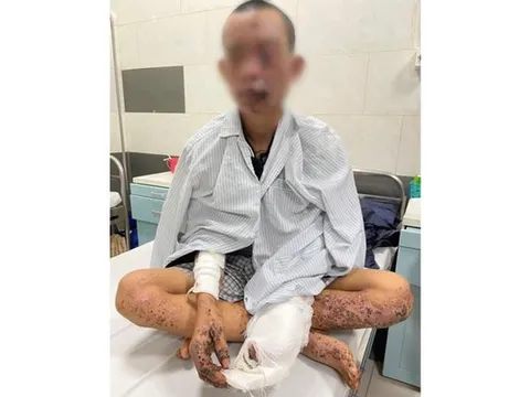 Dùng điện thoại khi đang sạc, nam thanh niên bị cháy sém toàn thân, nguy cơ mù