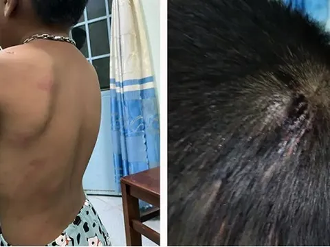 Bắt tạm giam người cha nhiều lần đánh đập, hành hạ con trai 6 tuổi