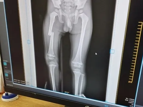 Thông tin mới nhất vụ người mẹ đạp gãy xương đùi con trai ở Bắc Giang