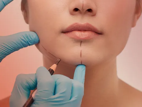 Phẫu thuật thẩm mỹ có phải làm lại thẻ căn cước công dân?